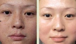 徒手祛斑爆料视频大全下载,视频大全下载攻略